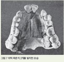 그림 7 위턱 측문치 2개를 발치한 모습